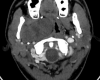 CT Scan Analysis