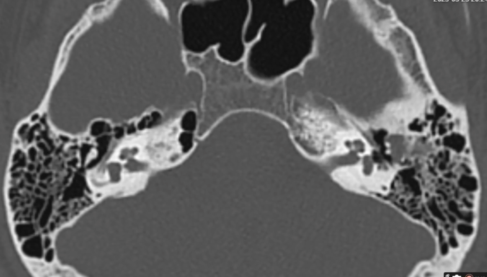 MRI Scan Analysis